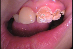 前歯に虫歯がある症例治療中