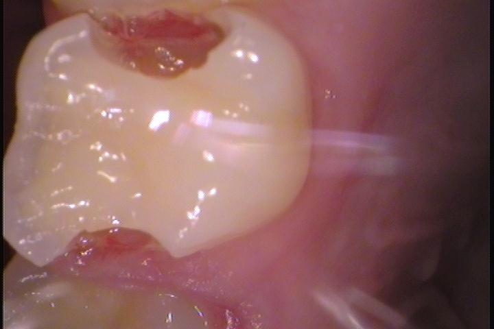奥歯に虫歯がある症例2術前